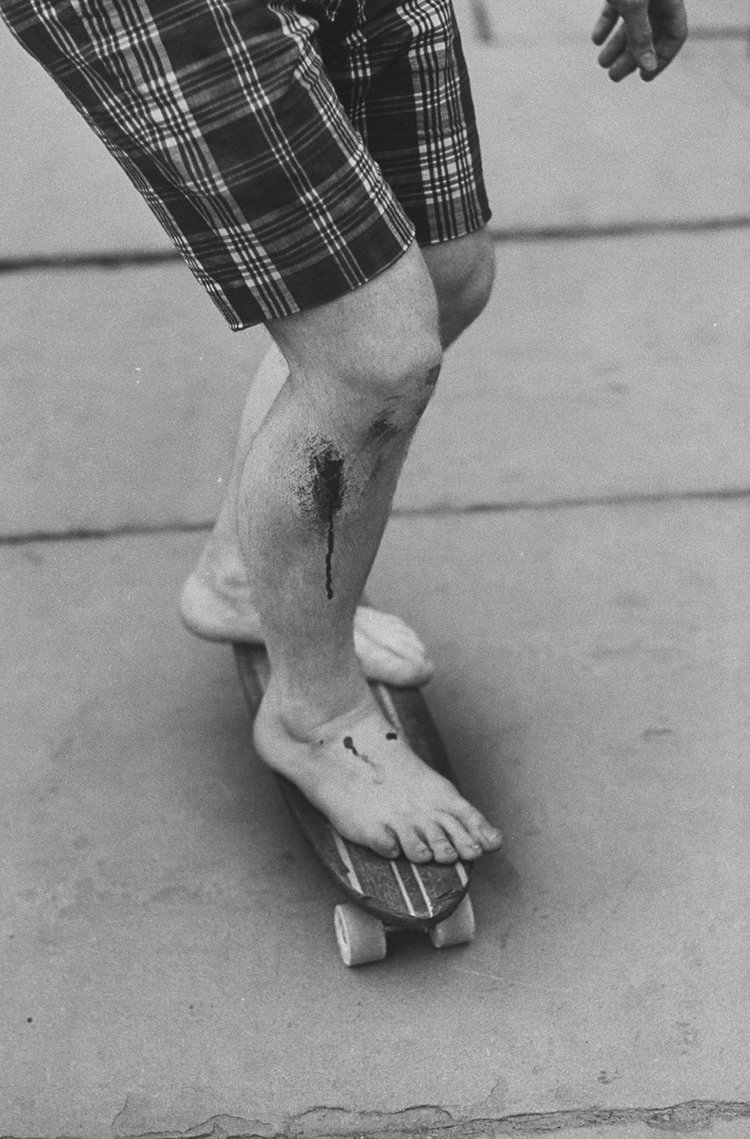 A barefooted skater shows off some fresh road rash.